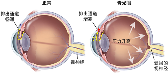 世界青光眼周——关注眼健康，国际奥比斯助力青光眼防治工作