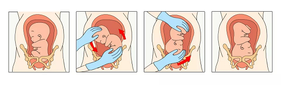 宝宝臀位？看新世纪妇儿医生如何徒手转胎位！(图2)