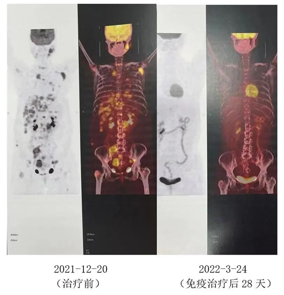 6年滤泡性淋巴瘤复发转移 上海孟超肿瘤医院免疫治疗逆转病情