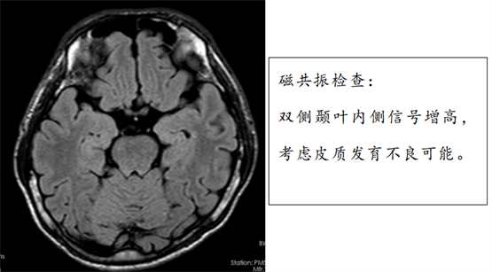 药物难治性癫痫患者体内植入新型抗癫痫电子药，控制癫痫发作