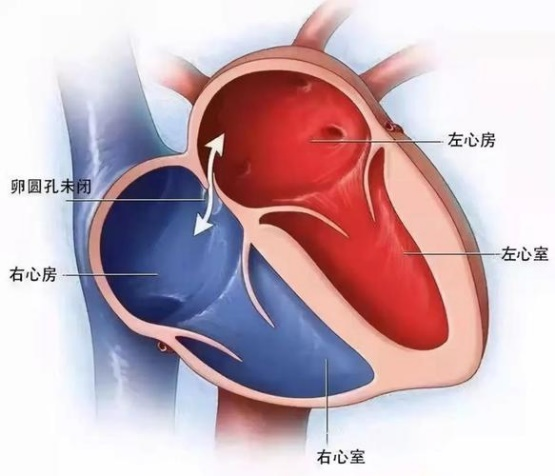 合作共赢！唯柯医疗D-shufo™新一代卵圆孔未闭封堵器启动招商