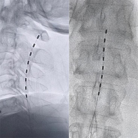 脊髓电刺激术如何关闭脑梗后疼痛