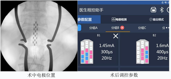 朝阳医院马立新团队仿生SCS为高位截瘫患者重启运动希望